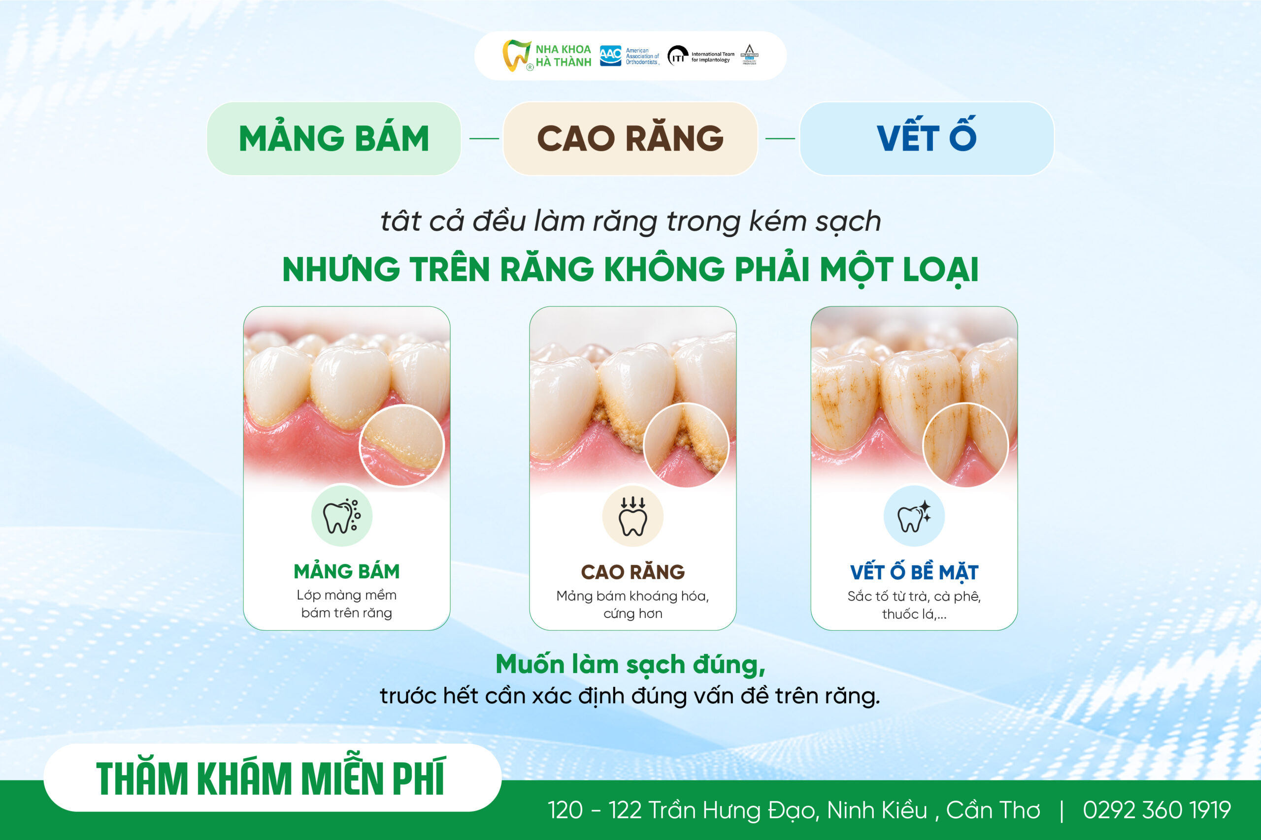 phân biệt mảng bám, cao răng và vết ố