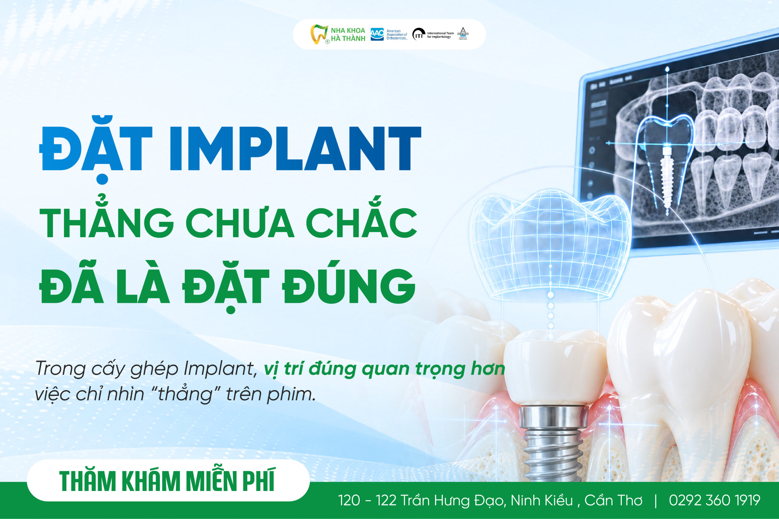 Vị trí đặt Implant – vì sao đặt thẳng chưa chắc đã đúng