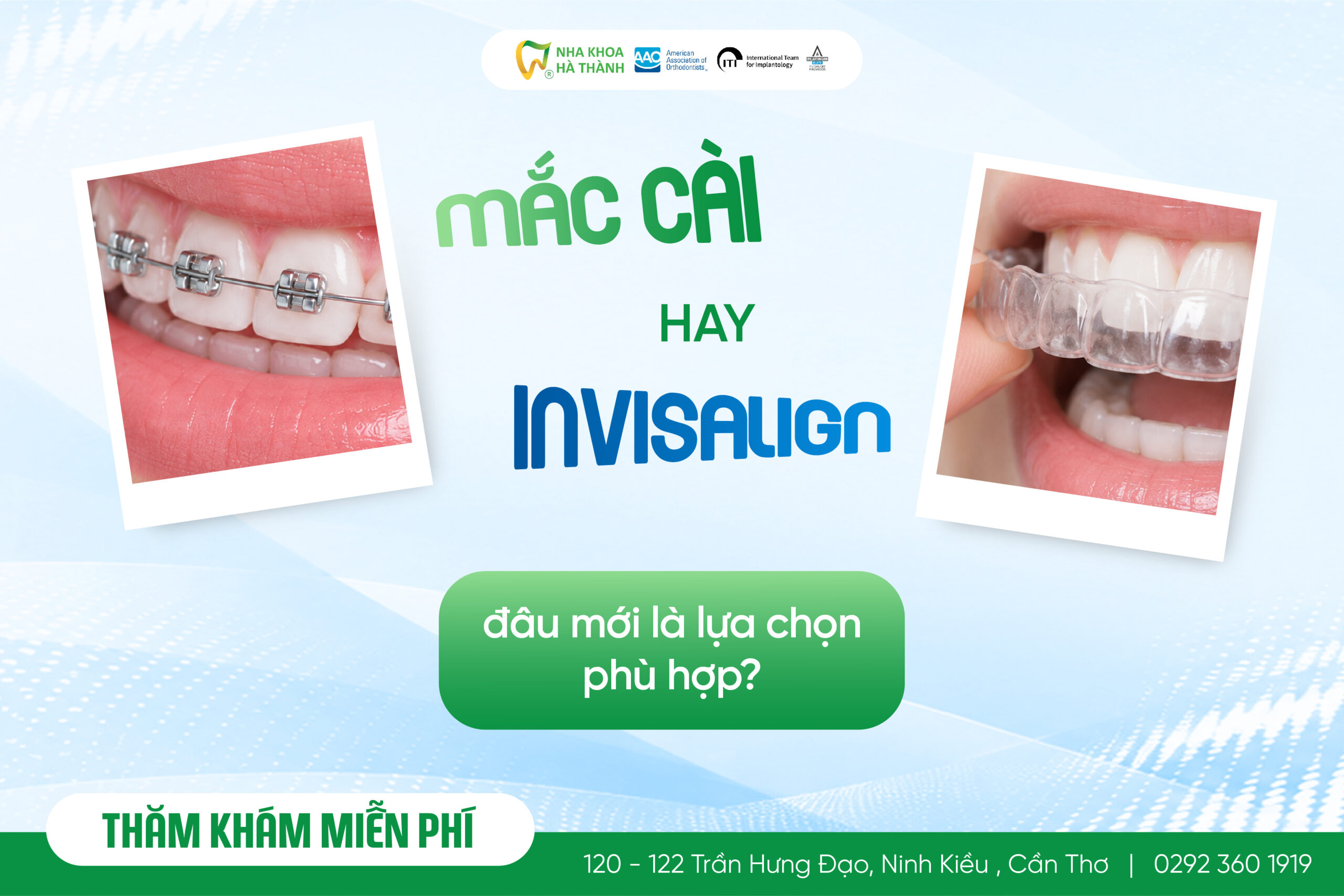 mắc cài hay Invisalign